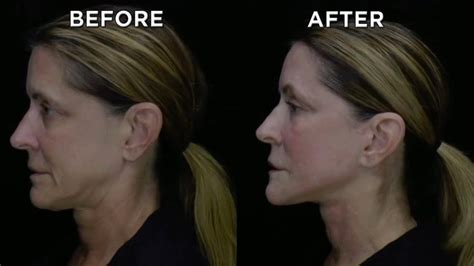 for her husband with the help of plastic surgery went all wrong. . Neck lifts gone wrong